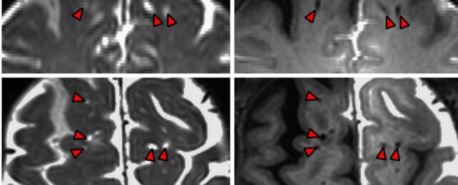 MRI scans of brains with red arrows