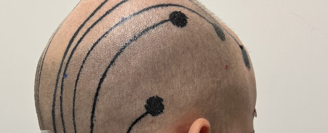 Head scalp e-tattoos