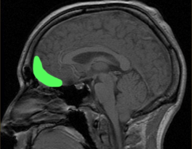 A brain scan with a bright green section at the front