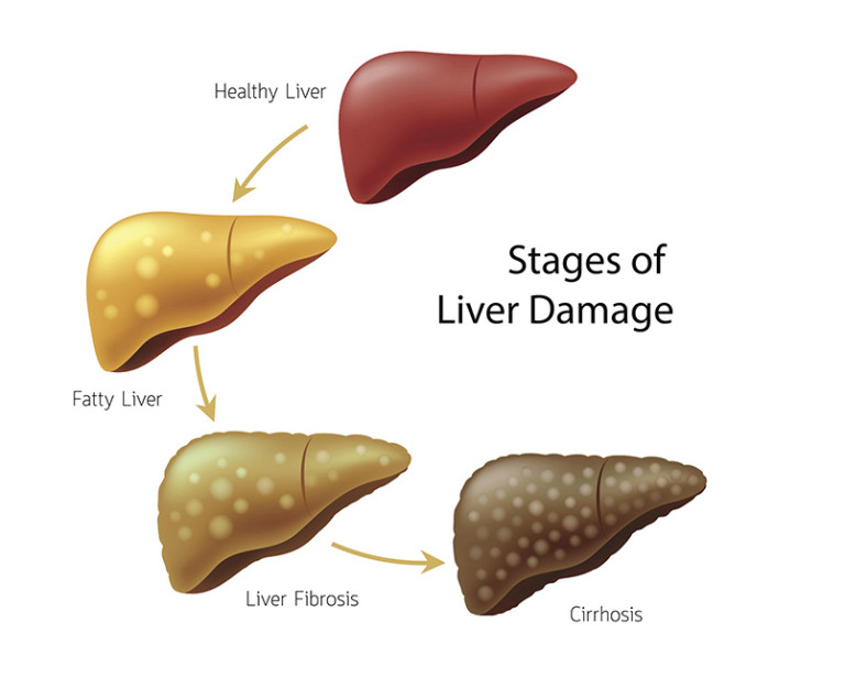 diagram showing the different stages of liver damage